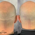 Scalp Micropigmentation: Your Answer to Natural-Looking Hair Restoration