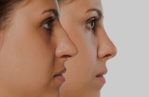 comparative portrait of a young woman before and after nose correction